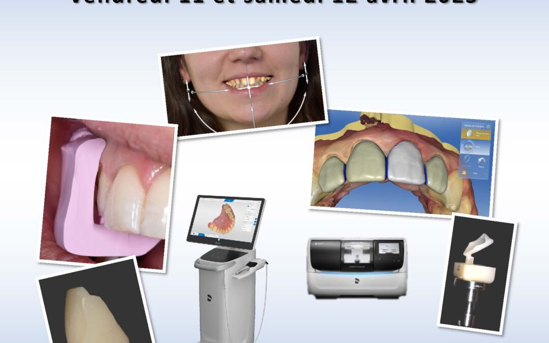 Stage Facettes avec le système CEREC