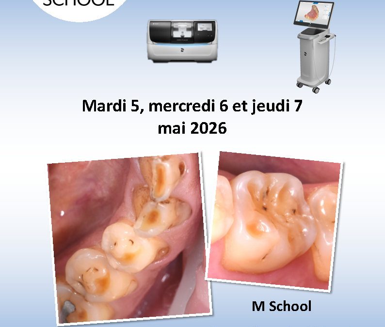Prise en charge des érosions sévères par CFAO directe 2026